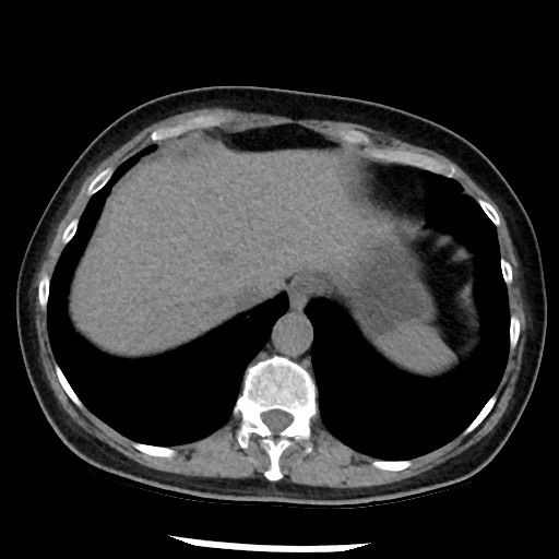 Amyloidosis - bronchial and diffuse nodular pulmonary involvement (Radiopaedia 60156-67744 Axial non-contrast 49).jpg