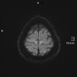 File:Amyotrophic lateral sclerosis (Radiopaedia 70821-81017 Axial DWI 15).jpg