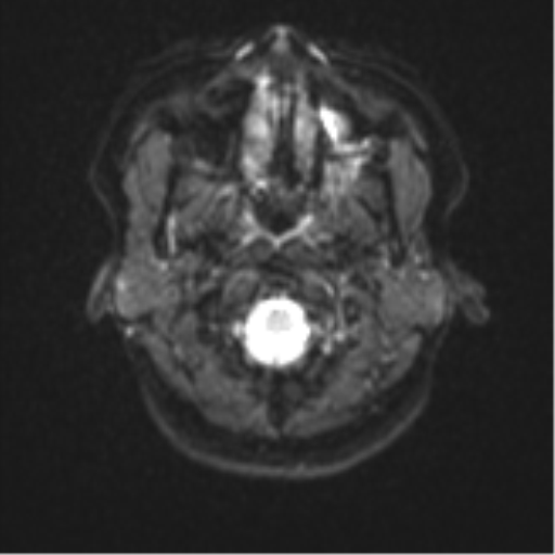 Anaplastic astroblastoma (Radiopaedia 55666-62194 Axial DWI 2).png
