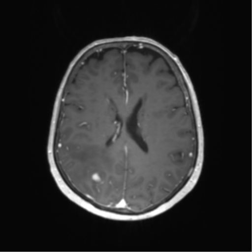 File:Anaplastic astrocytoma (Radiopaedia 86943-103160 Axial T1 C+ 43).png