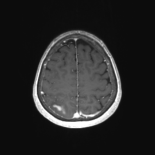 File:Anaplastic astrocytoma (Radiopaedia 86943-103160 Axial T1 C+ 68).png