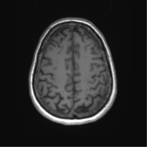 File:Anaplastic astrocytoma - thalamic glioma (Radiopaedia 59709-67115 Axial T1 32).png