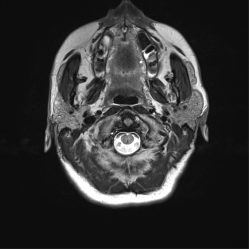 File:Anaplastic astrocytoma - thalamic glioma (Radiopaedia 59709-67115 Axial T2 1).png
