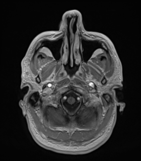 File:Anaplastic astrocytoma IDH wild-type (Radiopaedia 49984-55273 Axial T1 C+ 8).png