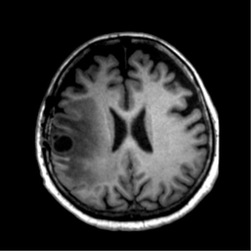 Anaplastic astrocytoma IDH wild-type (pseudoprogression) (Radiopaedia 42209-45277 Axial T1 85).png