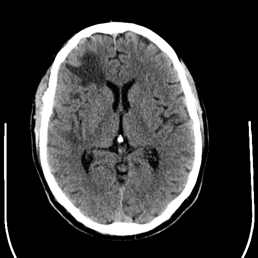 File:Anaplastic meningioma with recurrence (Radiopaedia 34452-35781 Axial non-contrast 17).png