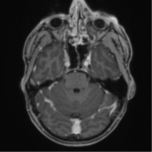 Anaplastic oligodendroglioma with skull fracture (Radiopaedia 74831-85845 Axial T1 C+ fat sat 16).png