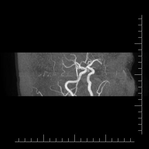 File:Aneurysm of posterior communicating artery (Radiopaedia 20188-20163 MRA 17).jpg