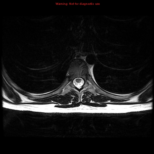 File:Aneurysmal bone cyst (Radiopaedia 9419-10103 Axial T2 3).jpg