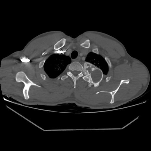 File:Aneurysmal bone cyst - rib (Radiopaedia 82167-96220 Axial bone window 61).jpg