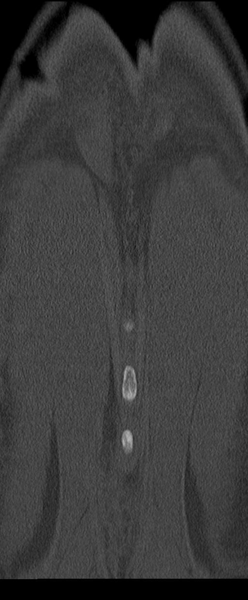 Aneurysmal bone cyst T11 (Radiopaedia 29294-29721 Coronal bone window 66).jpg