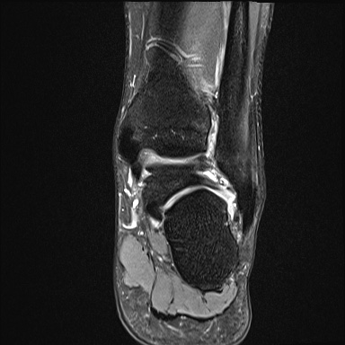 Ankle syndesmotic injury (Radiopaedia 69066-78837 Coronal PD fat sat 23).jpg