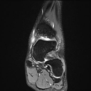 File:Ankle syndesmotic injury (Radiopaedia 69066-78837 Coronal PD fat sat 38).jpg