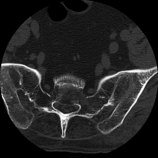Ankylosing spondylitis complicated by fracture-dislocation (Radiopaedia 33583-34674 Axial non-contrast 168).jpg