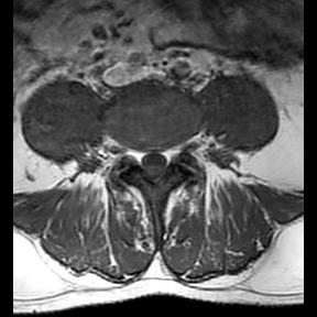 File:Ankylosing spondylitis with zygapophyseal arthritis (Radiopaedia 38433-40516 Axial T1 7).jpg