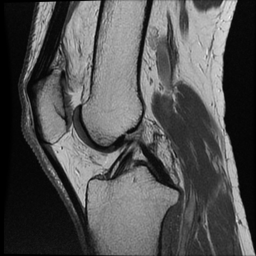 Anomalous insertion of the medial meniscus (Radiopaedia 77559-89721 Sagittal PD 28).jpg