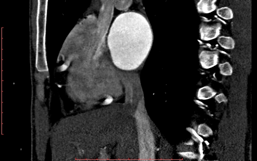 File:Anomalous left coronary artery from the pulmonary artery (ALCAPA) (Radiopaedia 70148-80181 C 62).jpg