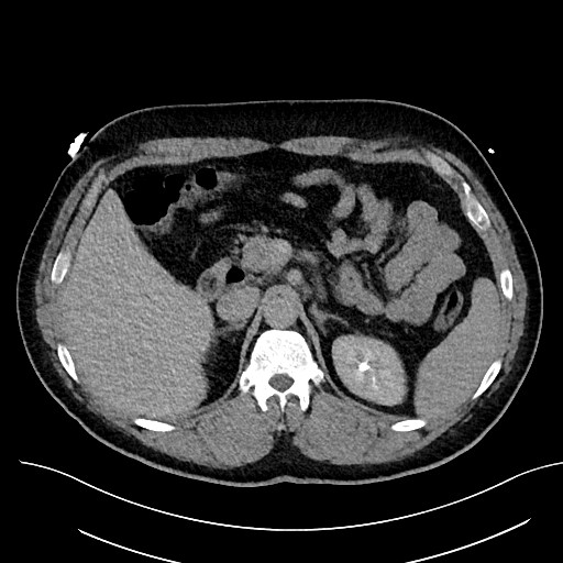 File:Anomalous origin of the left coronary artery with malignant course (Radiopaedia 77842-90126 Axial non-contrast 38).jpeg