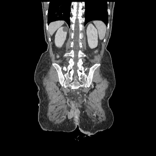 Anorectal carcinoma (Radiopaedia 44413-48064 B 71).jpg