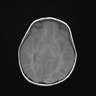 File:Anoxic brain injury (Radiopaedia 79165-92139 Axial T1 13).jpg