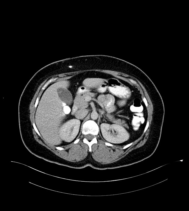 Anterior abdominal wall CSF pseudocyst (CSFoma) (Radiopaedia 79453-92571 A 33).jpg