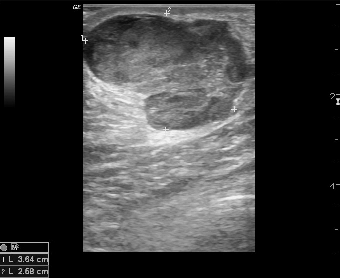 File:Anterior abdominal wall hematoma (Radiopaedia 11069-11472 A 1).jpg