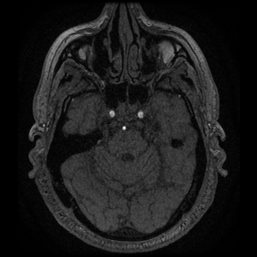 Anterior cerebral artery infarction (Radiopaedia 46794-51323 Axial MRA 43).jpg