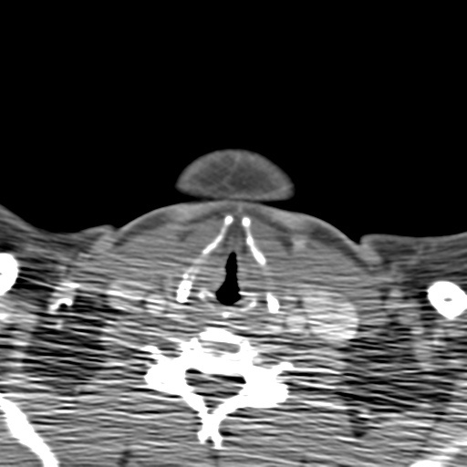 Anterior cerebral artery territory infarct (Radiopaedia 39327-41581 B 86).png
