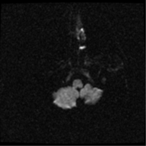File:Anterior cerebral artery territory infarct (Radiopaedia 39327-41584 Axial DWI 2).png