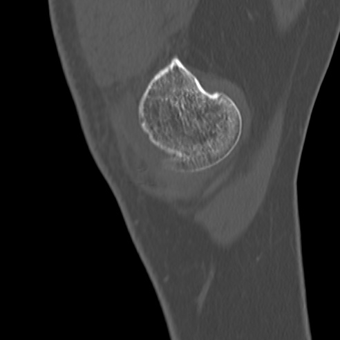 File:Anterior cruciate ligament avulsion fracture (Radiopaedia 58939-66194 Sagittal bone window 38).jpg