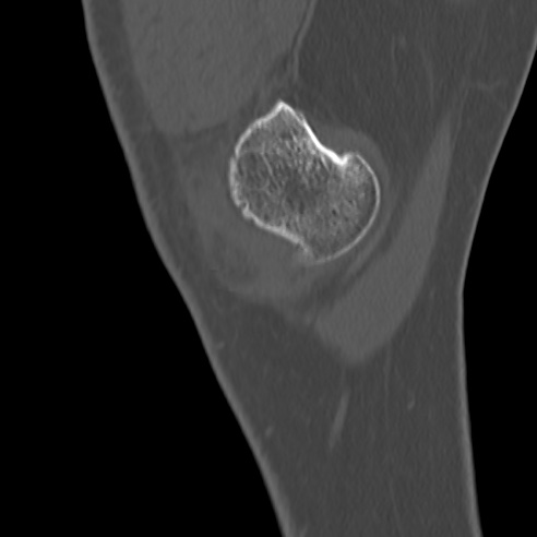 File:Anterior cruciate ligament avulsion fracture (Radiopaedia 58939-66194 Sagittal bone window 39).jpg
