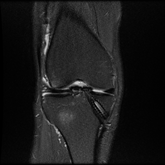 File:Anterior cruciate ligament graft tear and bucket-handle tear of medial meniscus (Radiopaedia 75867-87254 Coronal PD fat sat 10).jpg