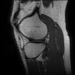 File:Anterior cruciate ligament rupture and posteromedial corner injury (Radiopaedia 67338-76723 Sagittal PD 127).jpg