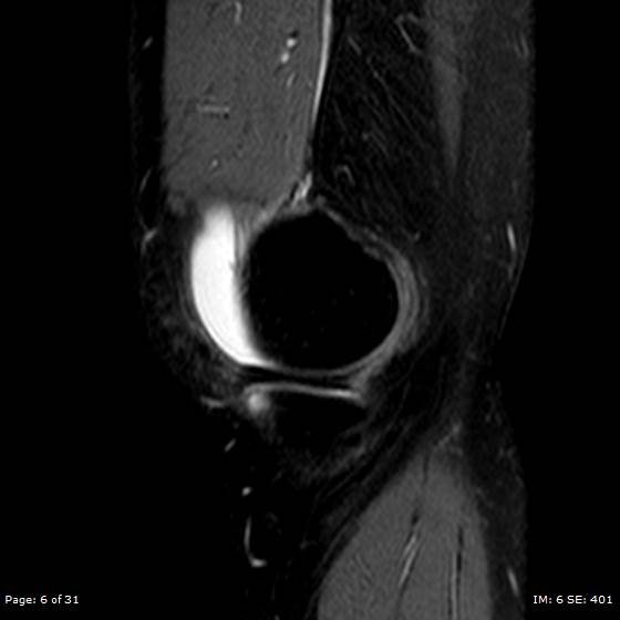 File:Anterior cruciate ligament tear (Radiopaedia 70783-80964 Sagittal STIR 6).jpg
