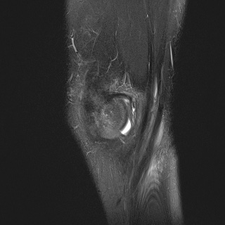 File:Anterior cruciate ligament tear - pediatric (Radiopaedia 62152-70260 Sagittal PD fat sat 7).jpg