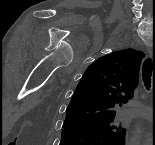 Anterior glenohumeral dislocation with Hill-Sachs lesion (Radiopaedia 62877-71249 Coronal bone window 52).jpg