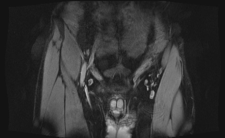 Anterior inferior iliac spine avulsion fracture (Radiopaedia 81312-95000 G 99).jpg