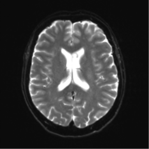File:Anterior temporal lobe perivascular space (Radiopaedia 40946-43650 Axial DWI 16).png