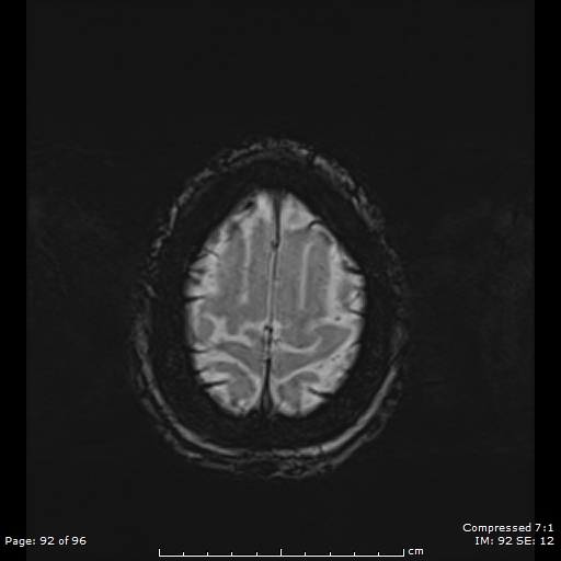 File:Anterior temporal lobe perivascular space (Radiopaedia 88283-104914 Axial SWI 61).jpg