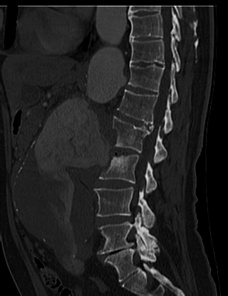 File:Anterior vertebral scalloping (abdominal aortic aneurysm) (Radiopaedia 66744-76067 Sagittal bone window 27).jpg