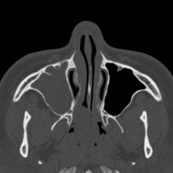 Antrochoanal polyp (Radiopaedia 33984-35202 Axial bone window 22).jpg