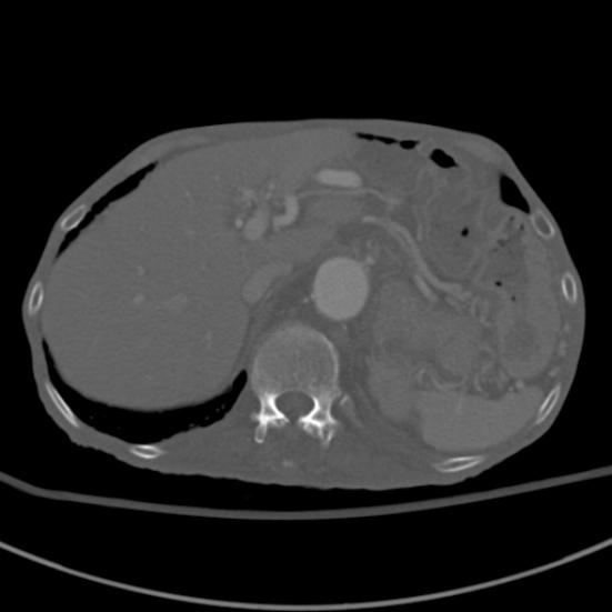 Aortic aneurysm with spinal destruction (Radiopaedia 42301-45410 Axial bone window 20).jpg