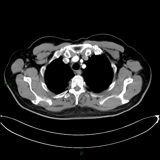 Aortic arch origin of left vertebral artery (Radiopaedia 46327-50737 Axial post contrast 23).jpg
