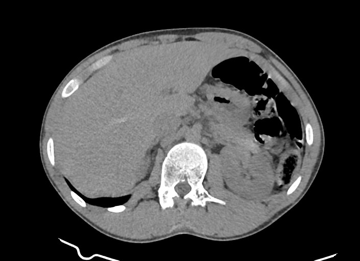 File:Aortic coarctation with aneurysm (Radiopaedia 74818-85828 A 23).jpg