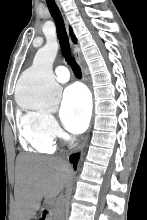 Aortic coarctation with aneurysm (Radiopaedia 74818-85828 B 83).jpg
