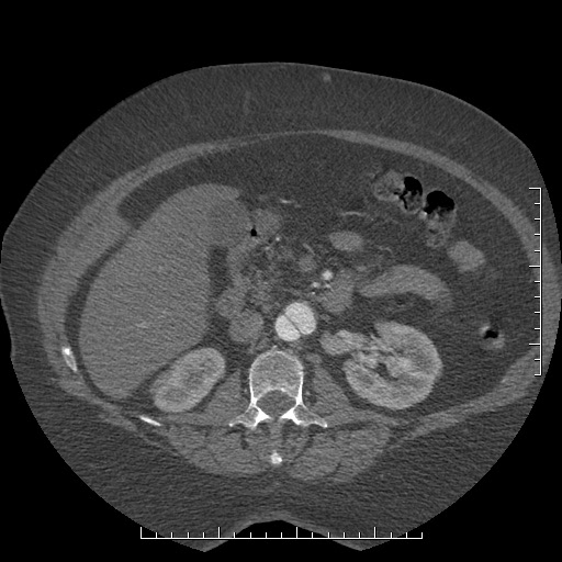Aortic dissection- Stanford A (Radiopaedia 35729-37268 B 66).jpg