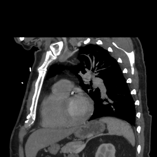 File:Aortic dissection- Stanford A (Radiopaedia 37759-39664 D 25).png