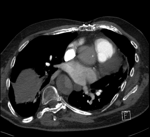 File:Aortic dissection (CTPA) (Radiopaedia 75506-86751 Axial C+ CTPA 79).jpg