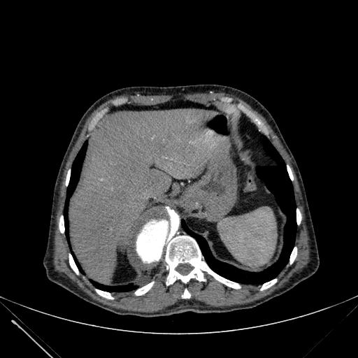 Aortic dissection (Radiopaedia 27466-27665 C+ arterial phase 258).jpg