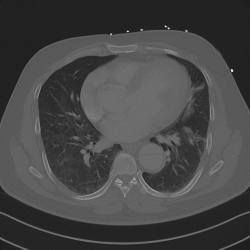 Aortic dissection (Radiopaedia 50763-56234 Axial bone window 63).png